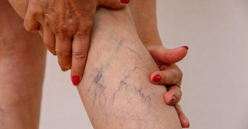 Varichosel nedir, işaretler nedir? Varikosel tedavisi nasıl yapılır?