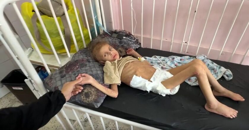 DSÖ: Gazze'de son 2 ayda 10 bin çocuğa akut yetersiz beslenme tanısı konuldu